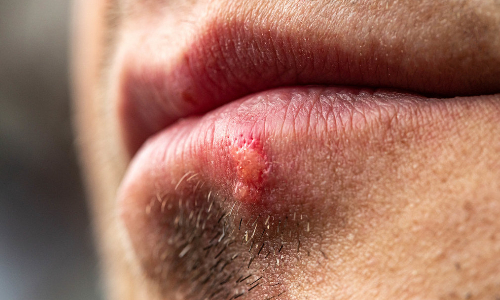 herpes treatment